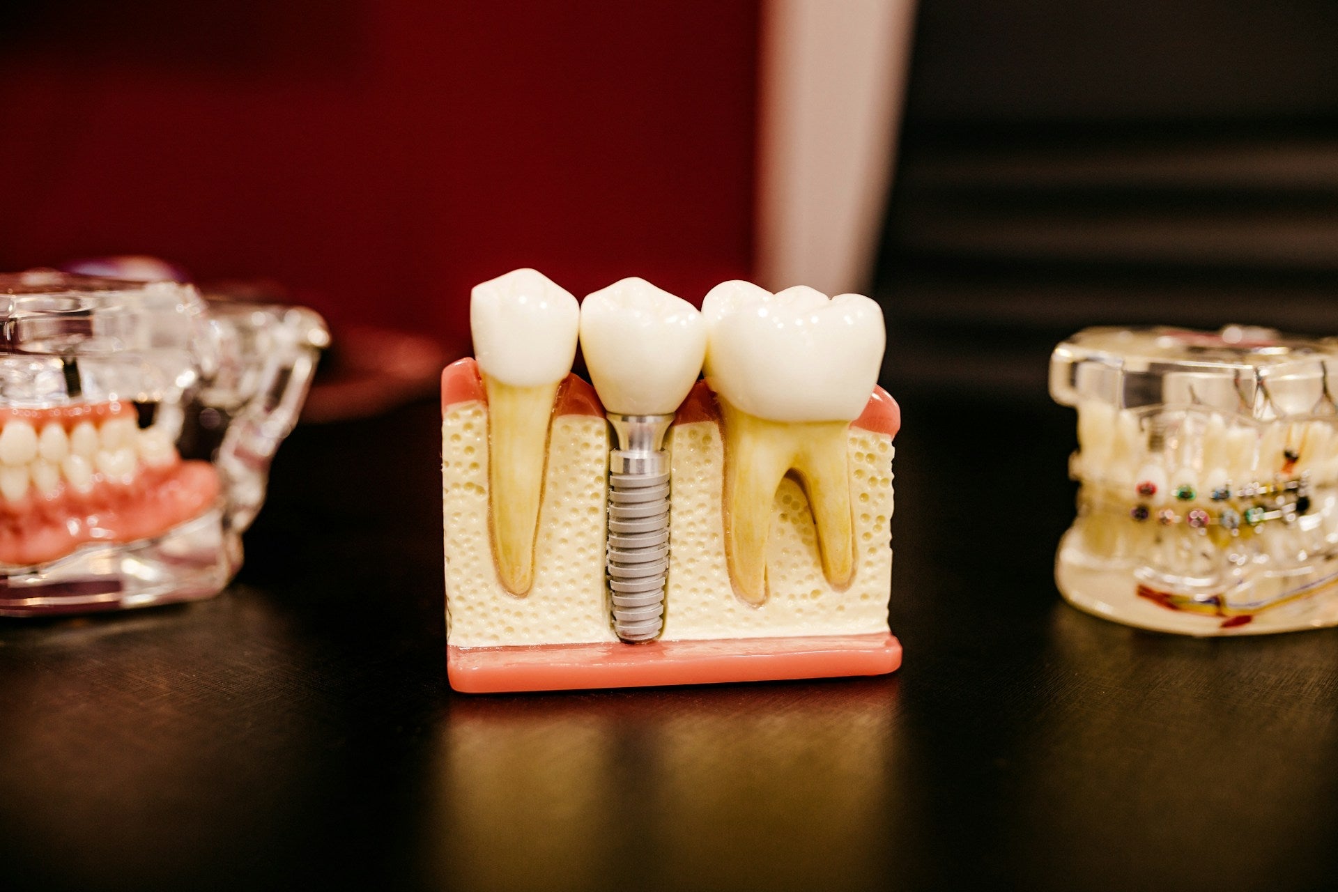 Modell das zwei natürliche Zähne und ein Implantat zeigt