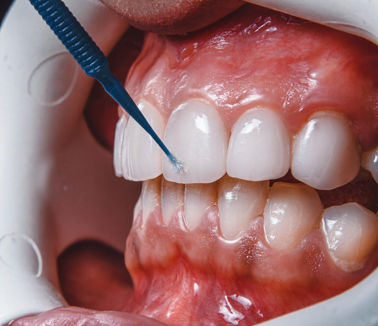 Fluoridierungspräparat wird auf Zähne aufgetragen