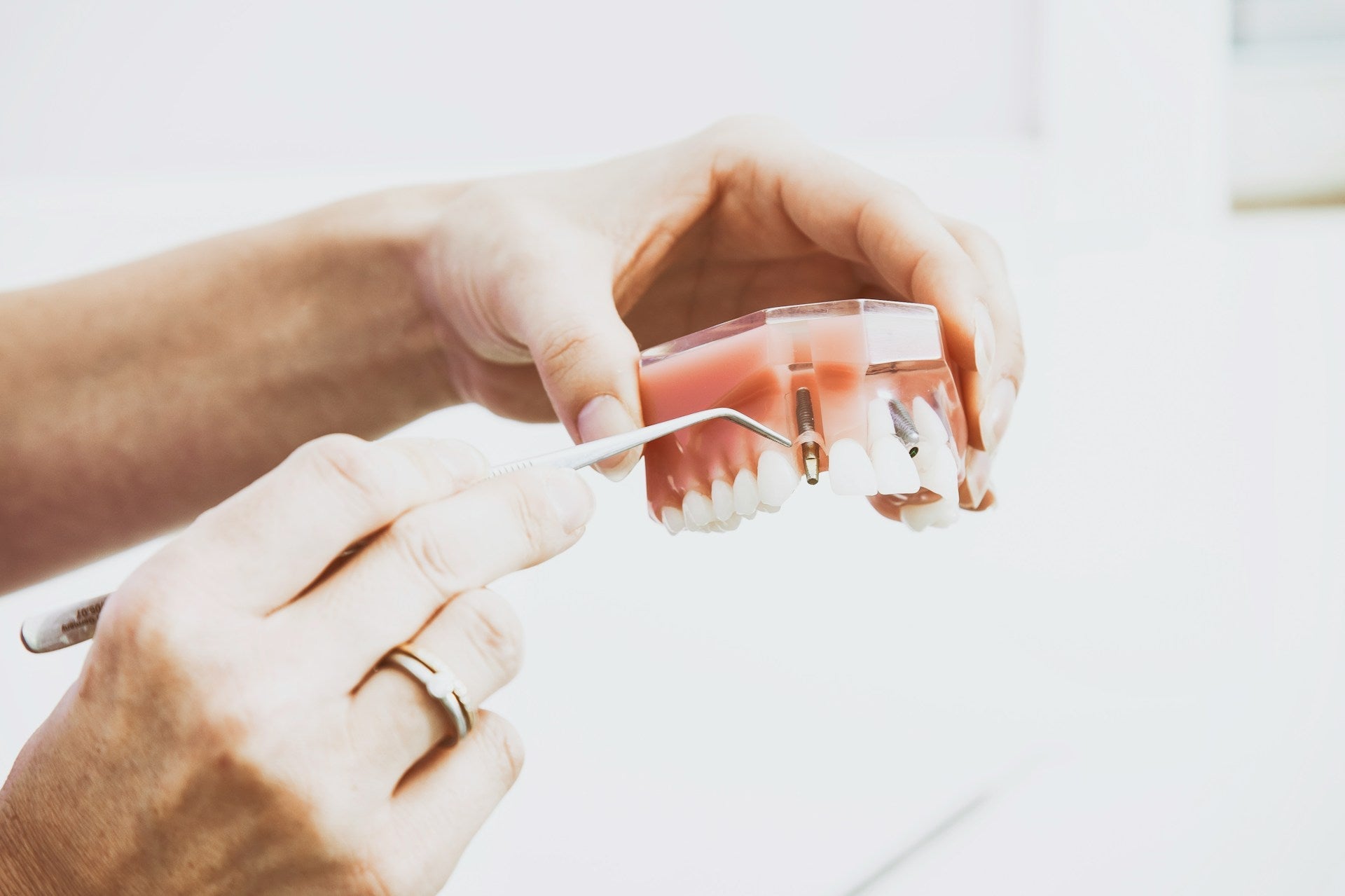 Implantat in einem Kiefermodell