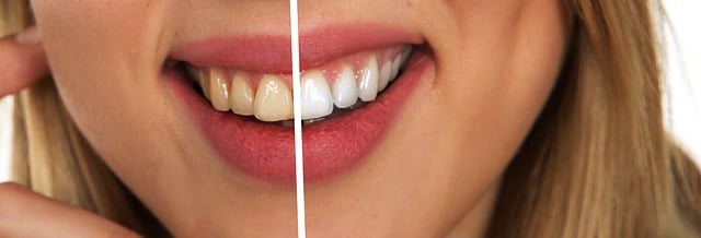 Gelbe Zähne: Wie Sie entstehen und was Sie tun können