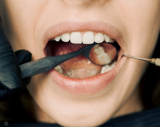Zahnfleischbluten: Warum es blutet und was Sie tun können