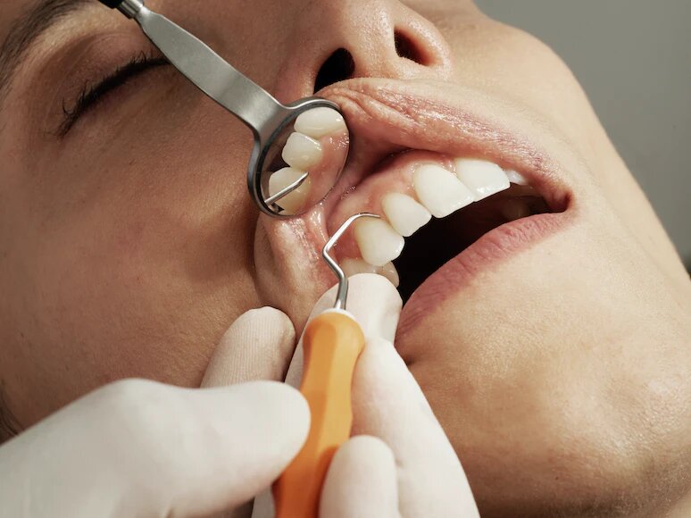 Warum Zahnfleischentzündungen gefährlich sind
